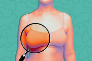 Breasts-Cancer-Symptoms-That-Aren't-Lumps-GettyImages-1298533194