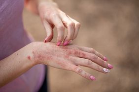 A woman's hands with eczema dermatitis