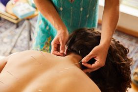 Woman receiving acupuncture. Practitioner is placing fine needles alongside either side of her spine.
