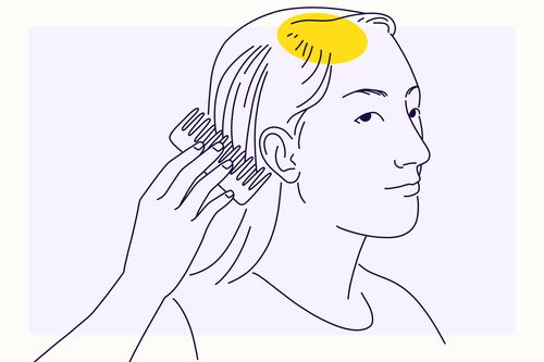 Overview illustration of Alopecia
