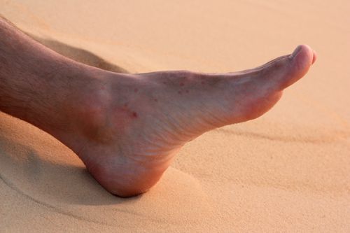 Foot with visible bites of the chigoe flea (or jigger) in the Sahara desert 