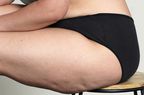 Cellulite on a woman's thigh