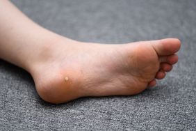 A plantar wart on a foot