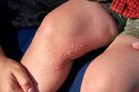 Stinging Nettle rash on leg