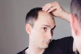 A man with male-pattern baldness looks in the mirror at his receding hairline