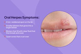 Photo Composite Oral Herpes