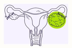 Illustration of ovarian cancer