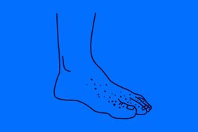 Illustration of a foot with a rash