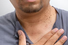 A man showing his skin tags