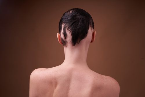 The back of the head of a young woman with brunette hair and alopecia (hair loss).