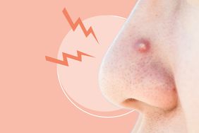 nose-pimple , close up of facial acne for health concept