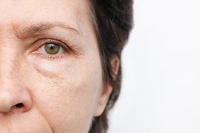 A cropped photo of an elderly woman with puffiness and wrinkles under her eyes