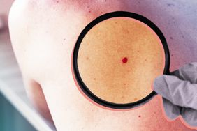 What-Is-Cherry-Angioma-Symptoms-Causes-and-Treatments-to-Know-GettyImages-1269238447-AdobeStock_261932228