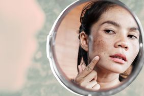 What-Is-Melasma-Dermatologists-Explain-the-Common-Skin-Issue-GettyImages-1179100510
